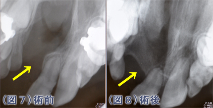 口蓋形成術例