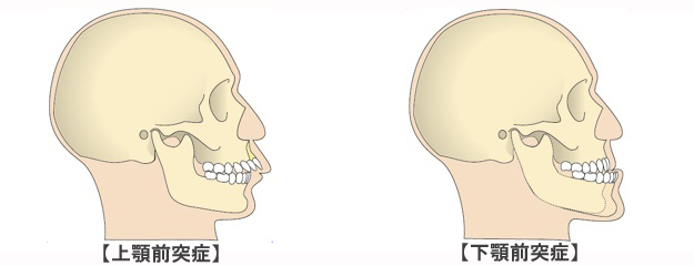 顎変形症イメージ