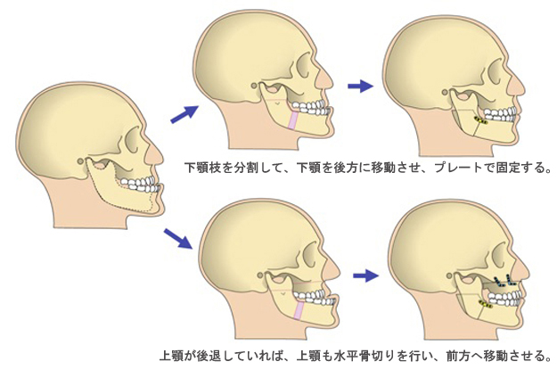 下顎前突症の手術