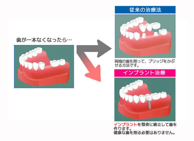 顎変形症イメージ